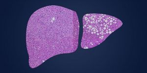 How targeting the ATF4 gene could help us fight alcoholic liver disease